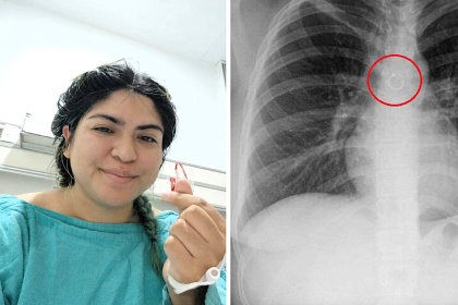 A TikToker nearly died after inhaling her nose ring, which lodged dangerously close to her aorta, leaving her facing emergency surgery after weeks of unexplained symptoms