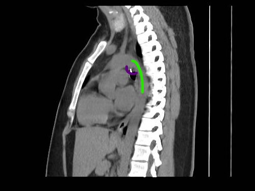 A TikToker nearly died after inhaling her nose ring, which lodged dangerously close to her aorta, leaving her facing emergency surgery after weeks of unexplained symptoms