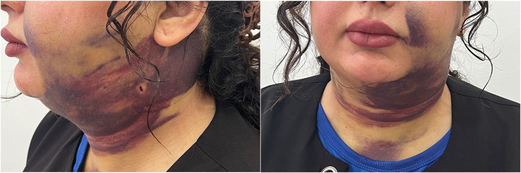 A 25-year-old was left struggling to breathe and covered in bruising after a chin liposuction procedure caused a dangerous blood clot to form under her skin just days later.