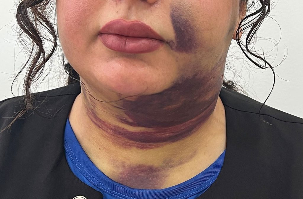 A 25-year-old was left struggling to breathe and covered in bruising after a chin liposuction procedure caused a dangerous blood clot to form under her skin just days later.
