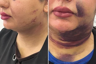 A 25-year-old was left struggling to breathe and covered in bruising after a chin liposuction procedure caused a dangerous blood clot to form under her skin just days later.