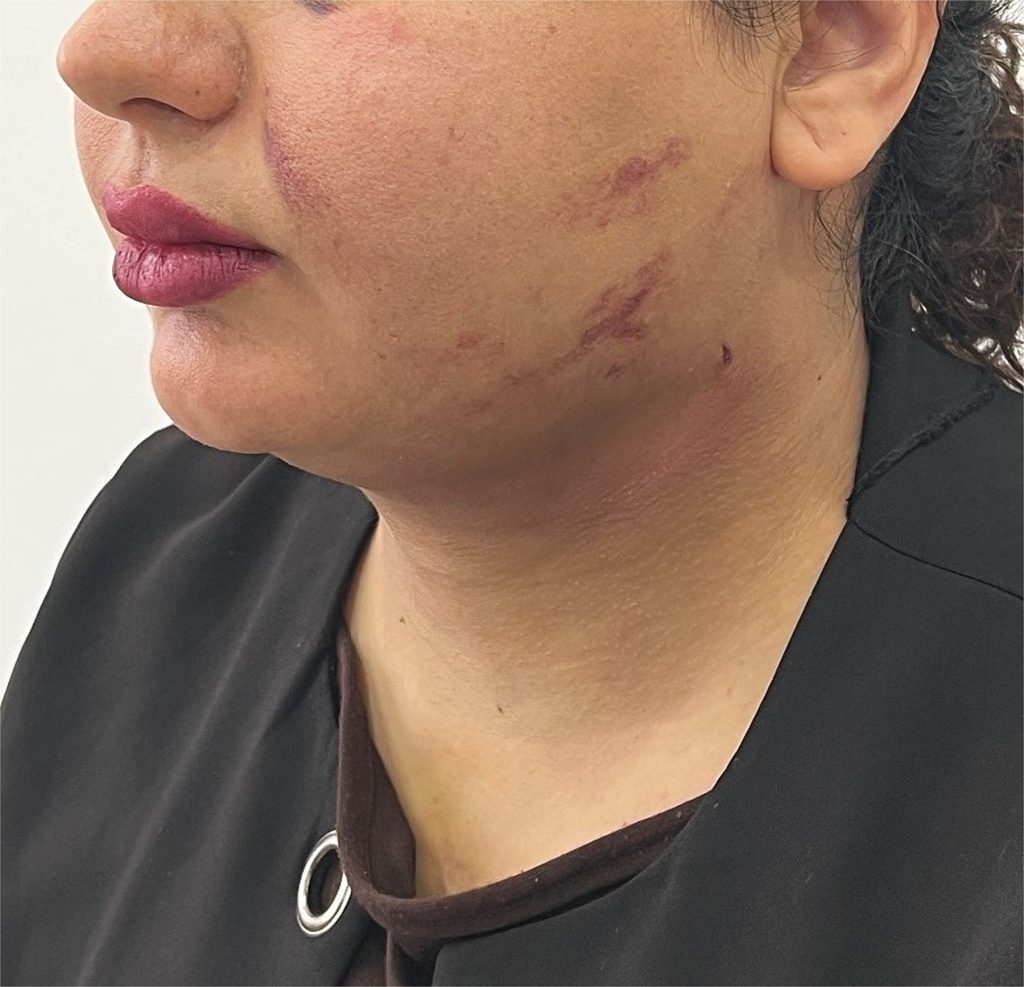 A 25-year-old was left struggling to breathe and covered in bruising after a chin liposuction procedure caused a dangerous blood clot to form under her skin just days later.
