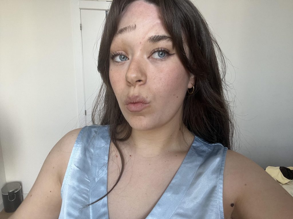 A nurse born with a rare skin condition causing facial folds is silencing trolls and embracing her unique look - with confidence she never expected to find.