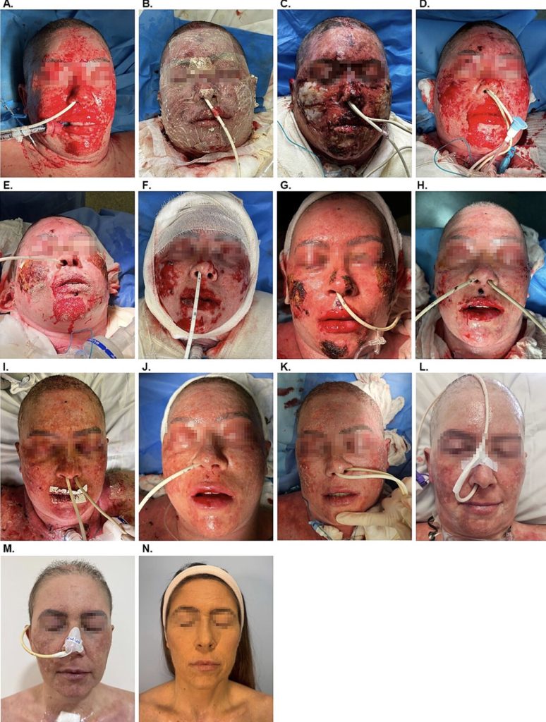 A woman's face burned and blistered after her depression medication triggered a rare deadly skin reaction. Her 66-day hospital recovery and incredible healing journey.