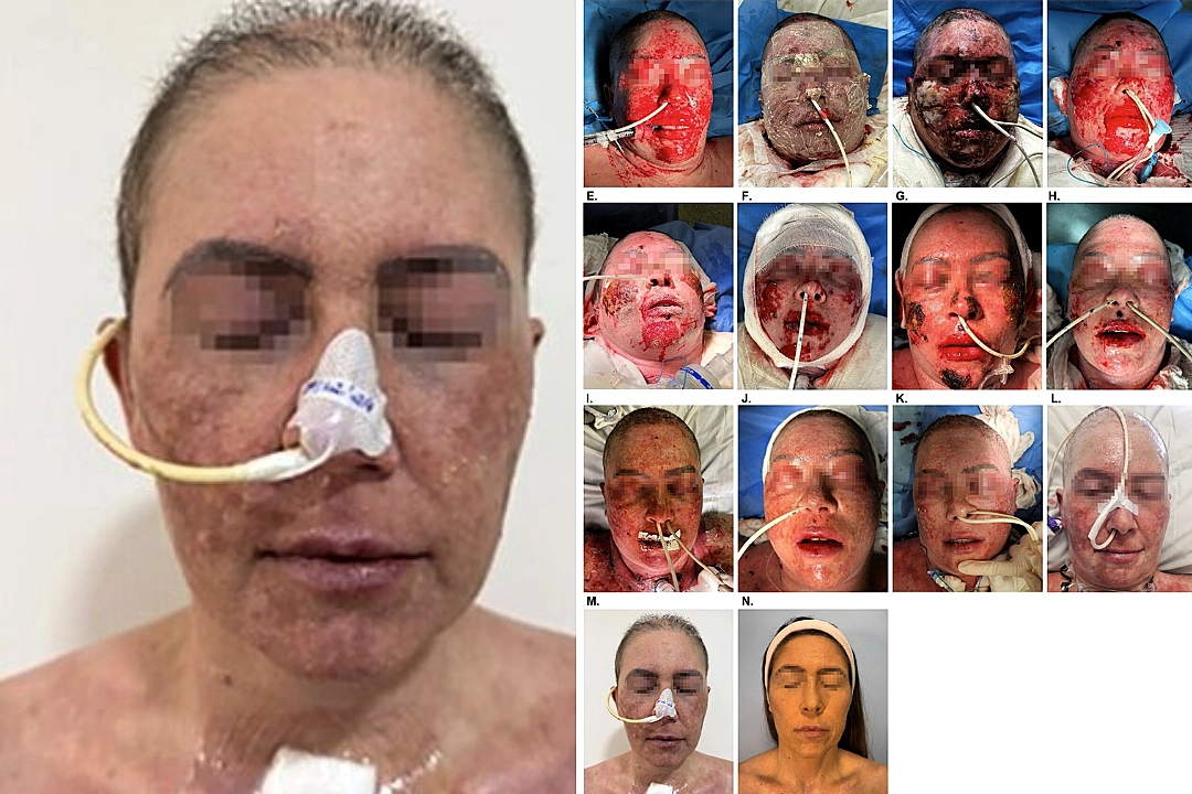 A woman's face burned and blistered after her depression medication triggered a rare deadly skin reaction. Her 66-day hospital recovery and incredible healing journey.