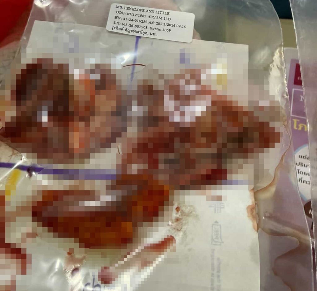 A 60-year-old woman who flew nearly 3,000 miles for a £10,000 facelift says trolls have been brutal about her swollen face as she recovers from the procedure.