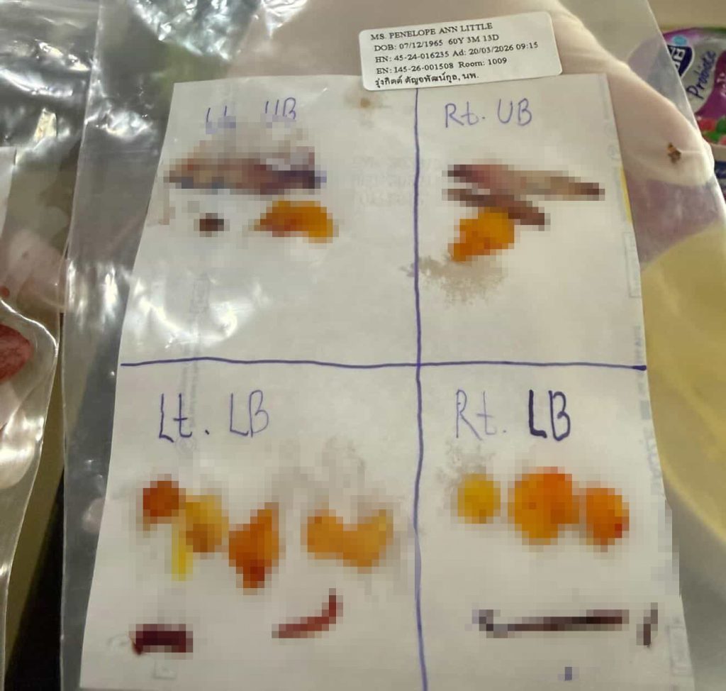 A 60-year-old woman who flew nearly 3,000 miles for a £10,000 facelift says trolls have been brutal about her swollen face as she recovers from the procedure.