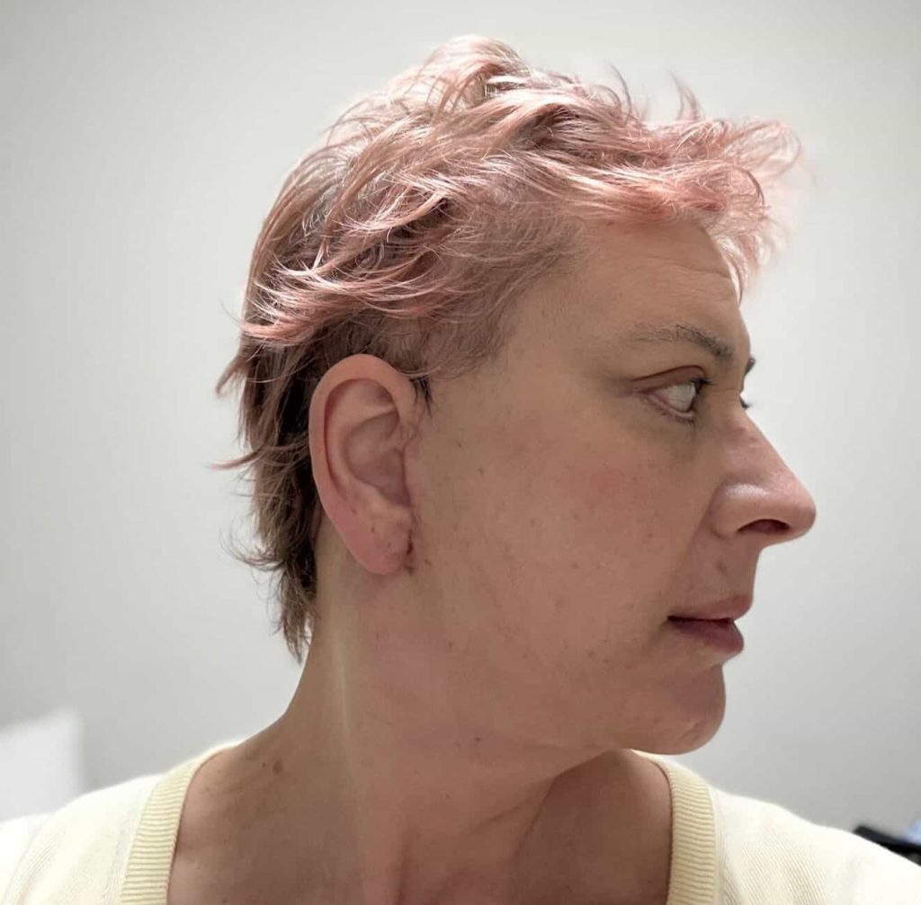 A 60-year-old woman who flew nearly 3,000 miles for a £10,000 facelift says trolls have been brutal about her swollen face as she recovers from the procedure.