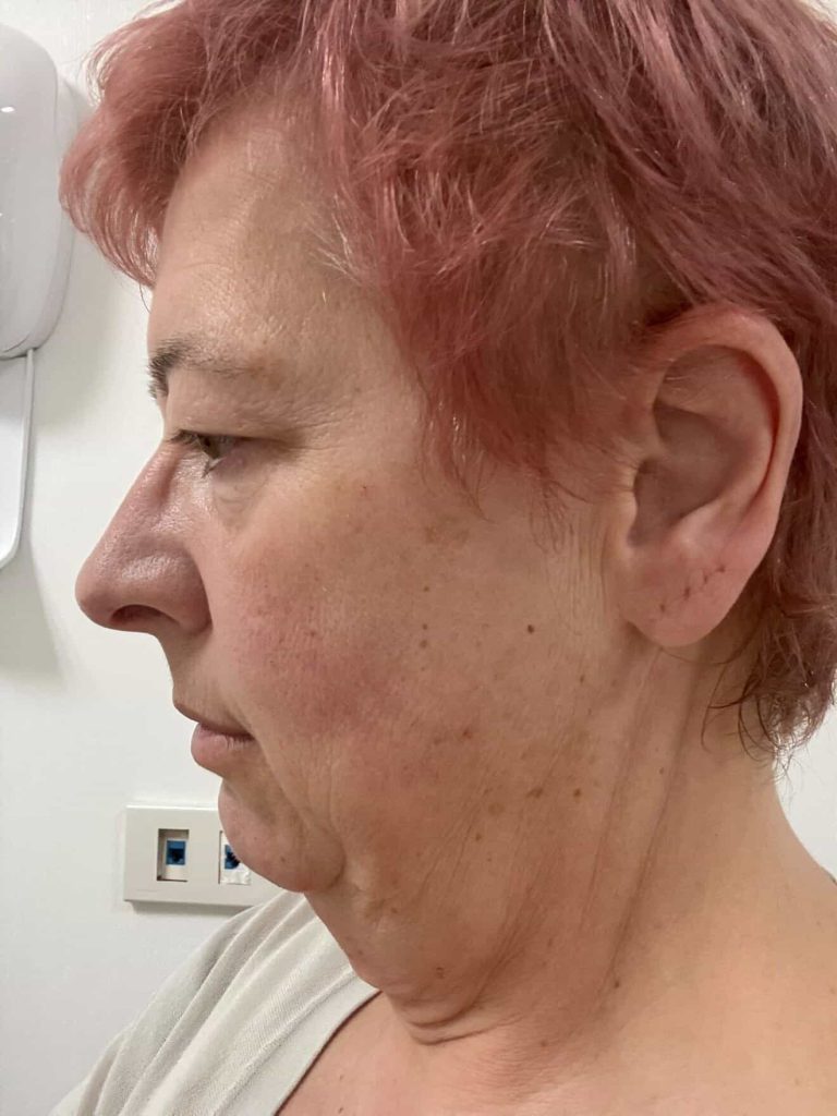 A 60-year-old woman who flew nearly 3,000 miles for a £10,000 facelift says trolls have been brutal about her swollen face as she recovers from the procedure.