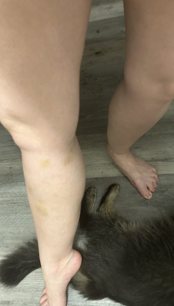 Mum Michelle Keith lost over 5 stone after discovering lipedema was behind her weight loss resistance - how anti-inflammatory eating and weight loss jabs changed her life.