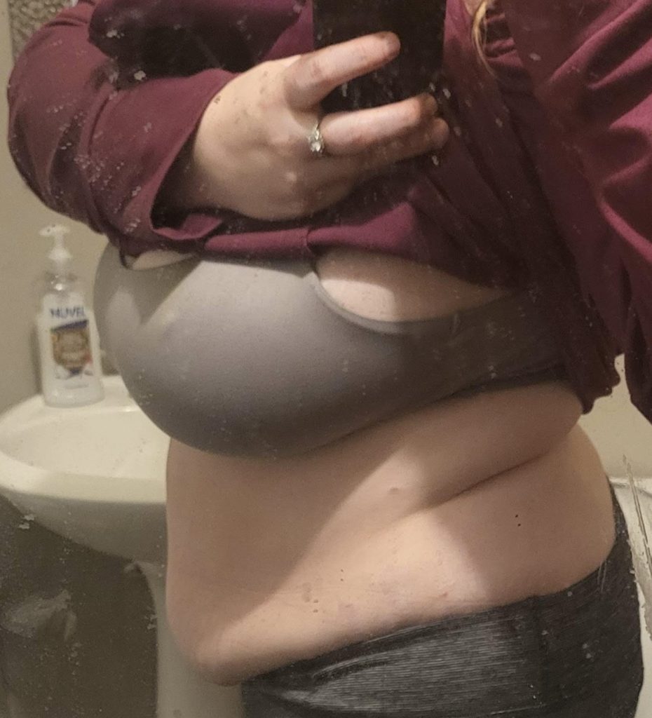 Mum Michelle Keith lost over 5 stone after discovering lipedema was behind her weight loss resistance - how anti-inflammatory eating and weight loss jabs changed her life.