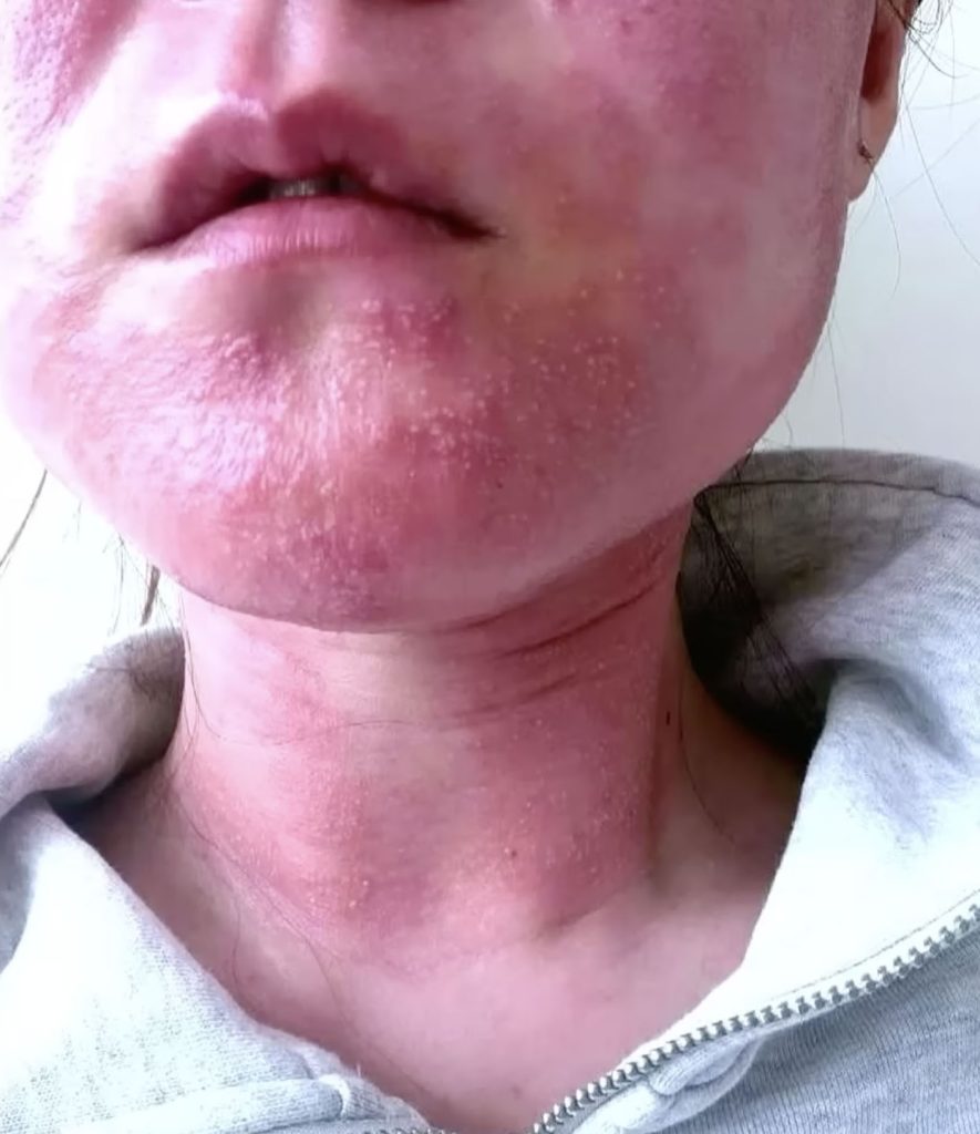 A bride-to-be was left disfigured and too traumatised to leave home without a mask after a microneedle treatment went horribly wrong before her wedding photoshoot.
