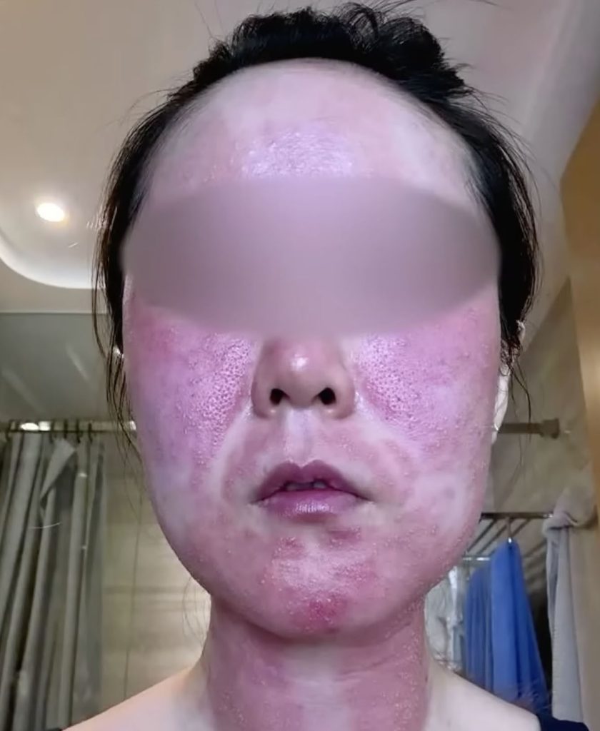 A bride-to-be was left disfigured and too traumatised to leave home without a mask after a microneedle treatment went horribly wrong before her wedding photoshoot.