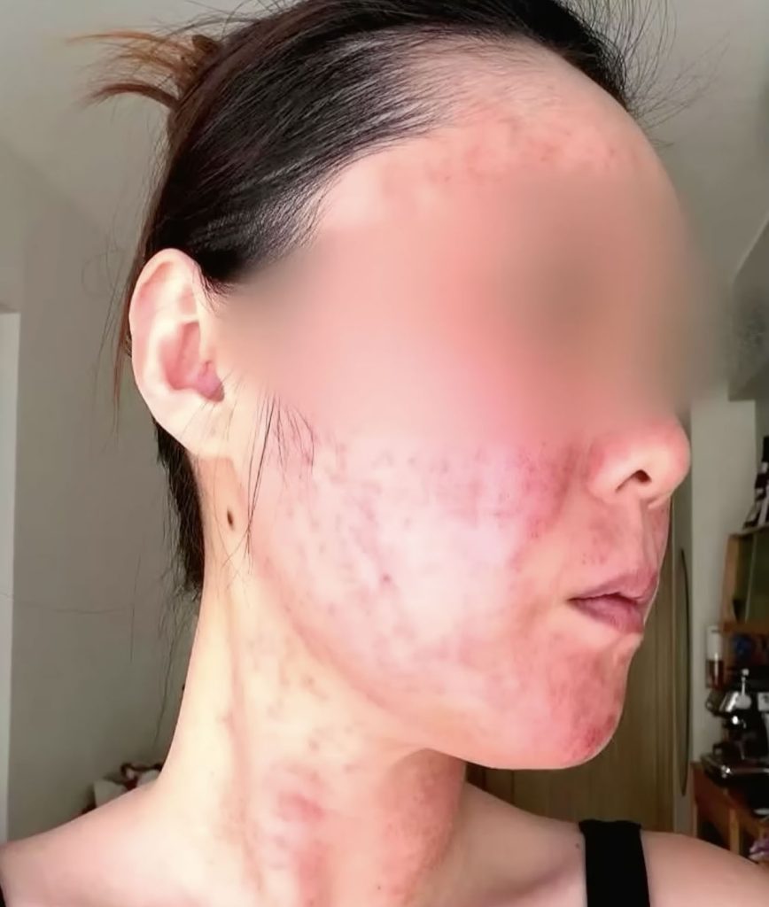 A bride-to-be was left disfigured and too traumatised to leave home without a mask after a microneedle treatment went horribly wrong before her wedding photoshoot.