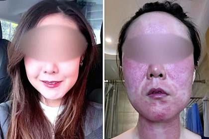 A bride-to-be was left disfigured and too traumatised to leave home without a mask after a microneedle treatment went horribly wrong before her wedding photoshoot.