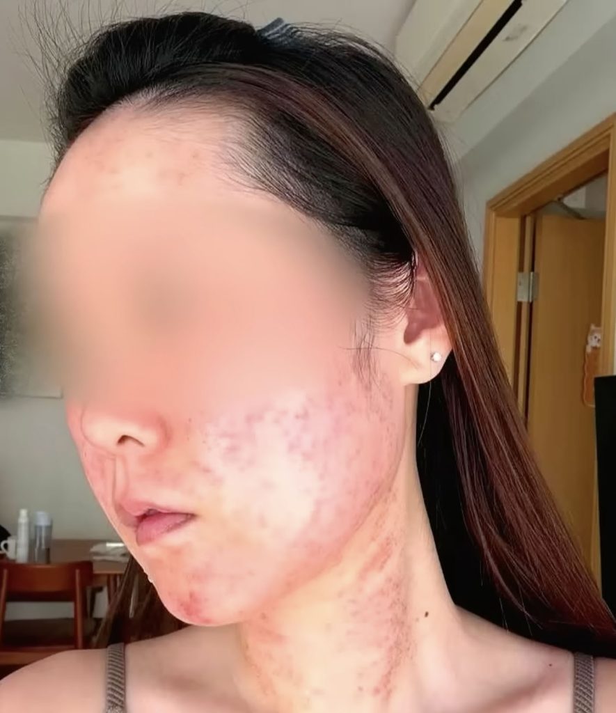 A bride-to-be was left disfigured and too traumatised to leave home without a mask after a microneedle treatment went horribly wrong before her wedding photoshoot.