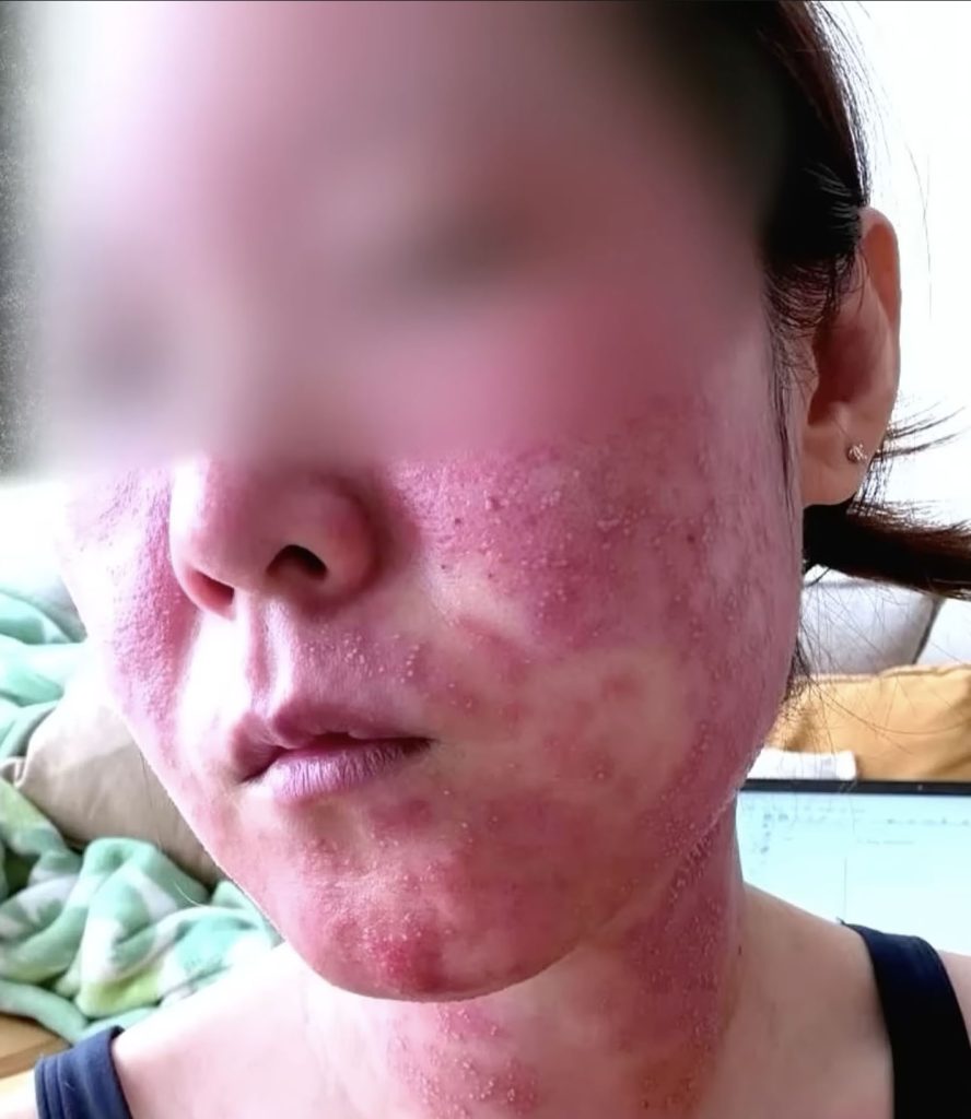 A bride-to-be was left disfigured and too traumatised to leave home without a mask after a microneedle treatment went horribly wrong before her wedding photoshoot.