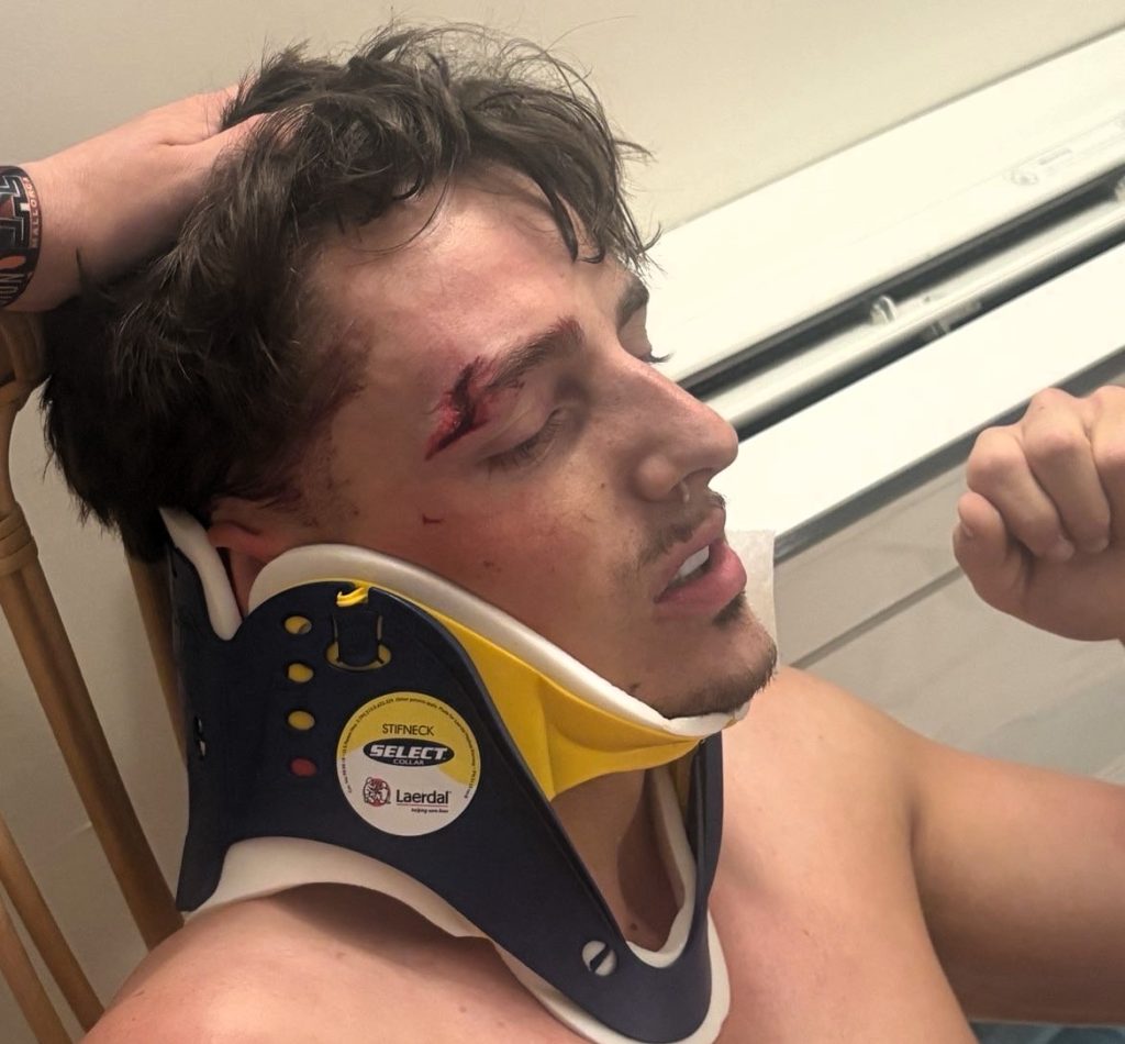 Brit left stranded on a lads holiday after a fractured eye socket and bruising on the brain stops him flying home - all thanks to his Lightning McQueen Crocs.