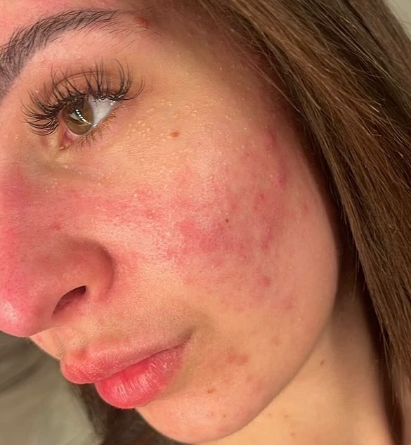 York woman Emily Howdle, 32, ditches makeup after a £16 holy grail serum cleared three-year acne battle that left her mortified in supermarket.