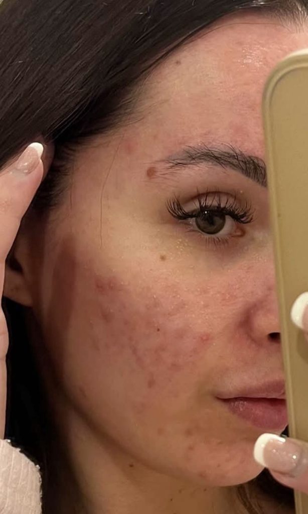 York woman Emily Howdle, 32, ditches makeup after a £16 holy grail serum cleared three-year acne battle that left her mortified in supermarket.