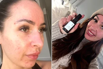York woman Emily Howdle, 32, ditches makeup after a £16 holy grail serum cleared three-year acne battle that left her mortified in supermarket.