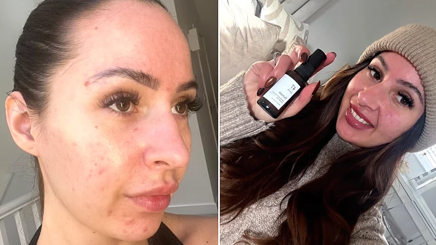York woman Emily Howdle, 32, ditches makeup after a £16 holy grail serum cleared three-year acne battle that left her mortified in supermarket.