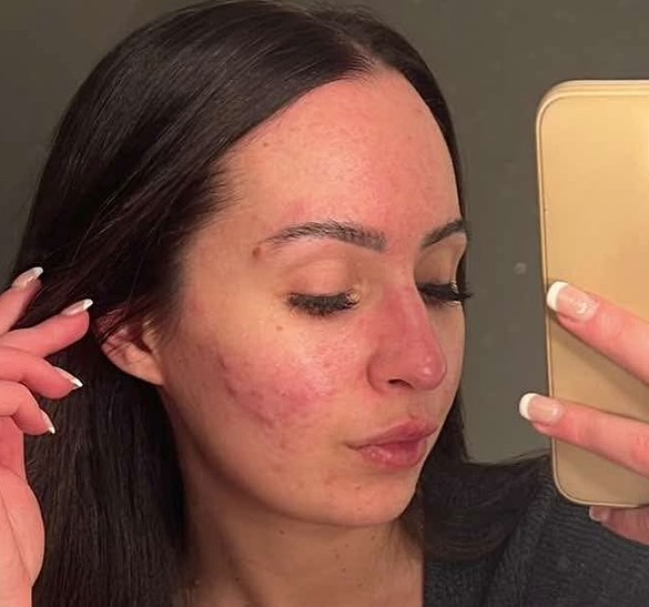 York woman Emily Howdle, 32, ditches makeup after a £16 holy grail serum cleared three-year acne battle that left her mortified in supermarket.
