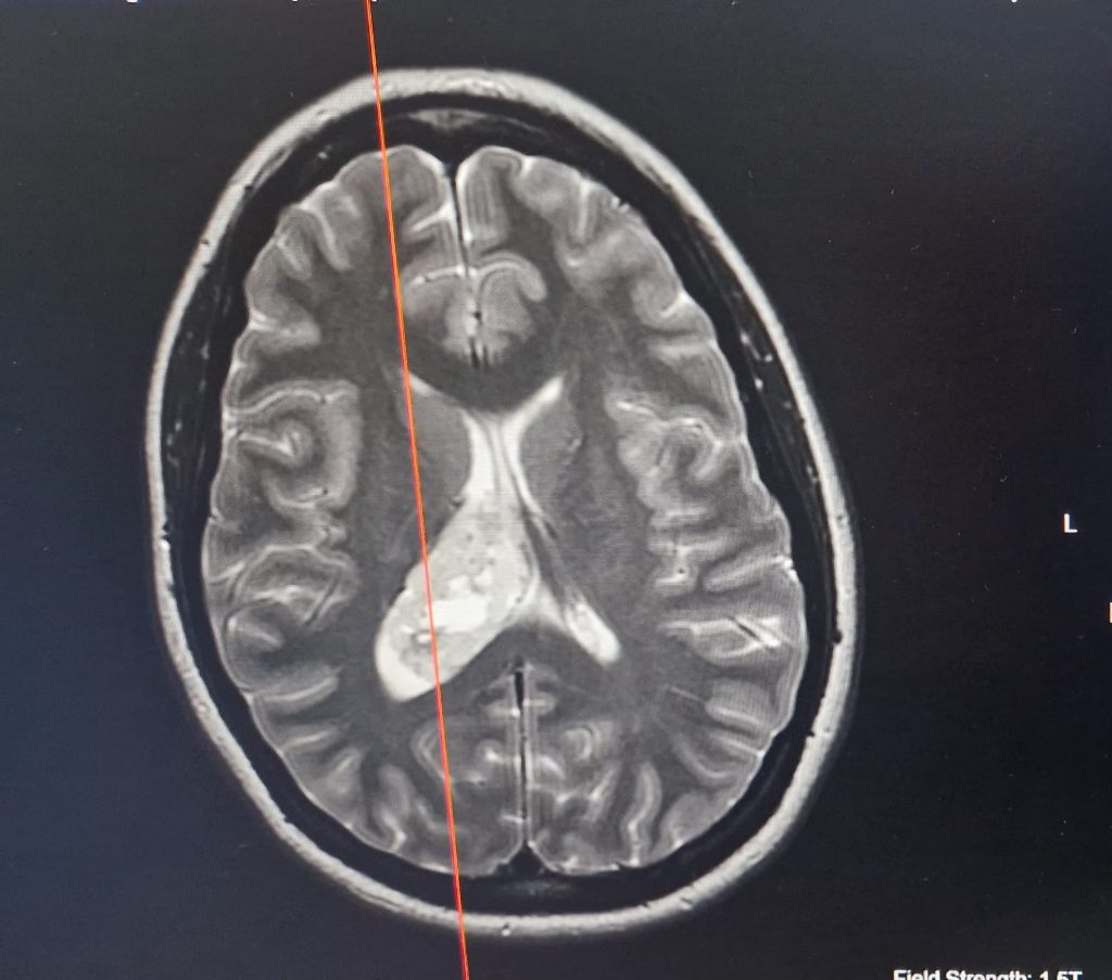 A British woman discovered a cancerous brain tumour after a routine MRI following a car accident - and says the crash may have saved her life.
