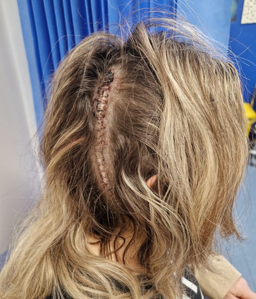 A British woman discovered a cancerous brain tumour after a routine MRI following a car accident - and says the crash may have saved her life.