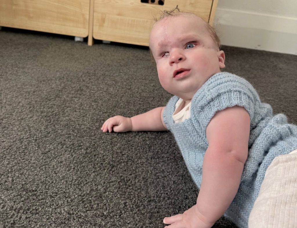 Mum's heartbreaking fears are confirmed when her baby is born with a band around his head - and doctors say the placenta is the greenest they have ever seen.