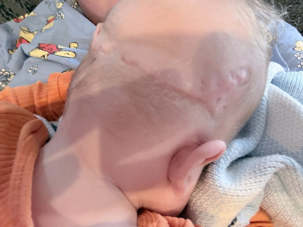 Mum's heartbreaking fears are confirmed when her baby is born with a band around his head - and doctors say the placenta is the greenest they have ever seen.