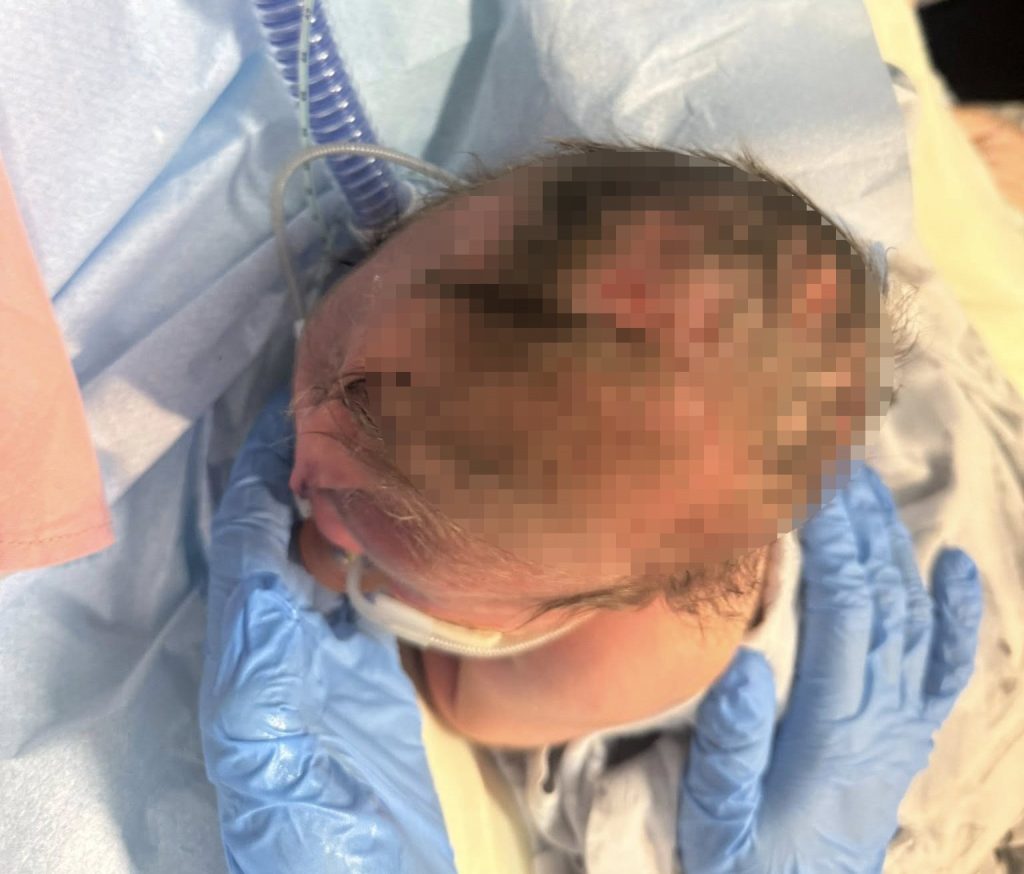 Mum's heartbreaking fears are confirmed when her baby is born with a band around his head - and doctors say the placenta is the greenest they have ever seen.