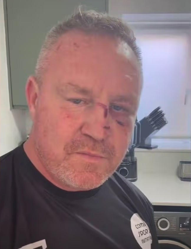 YouTuber Billy Moore suffered nasty faceplant injury after pothole flung him from scooter, then blasted Manchester mayor Andy Burnham over the city's road conditions.