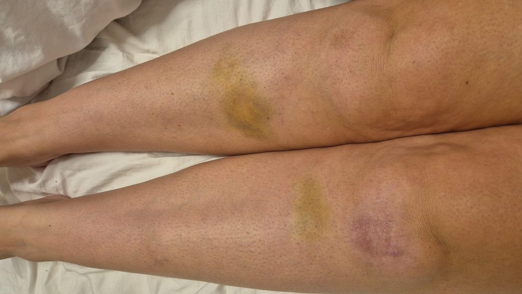 British woman living her dream life in Spain woke one morning in agony - within weeks she was completely paralysed and forced to leave it all behind.