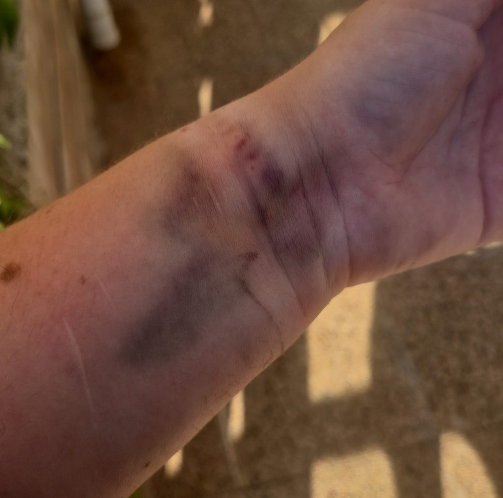 British woman living her dream life in Spain woke one morning in agony - within weeks she was completely paralysed and forced to leave it all behind.