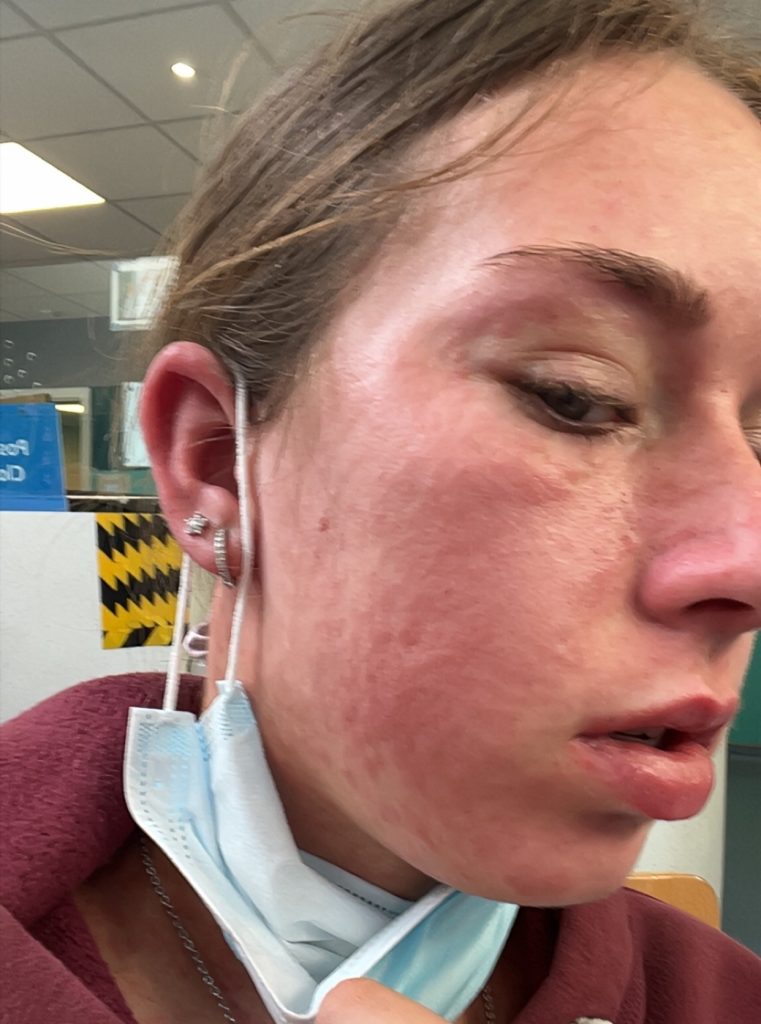 Childcare worker Mollie Lock, 18, thought she had flu - but ended up hospitalised with face swollen like a puffer fish after being struck down by glandular fever.