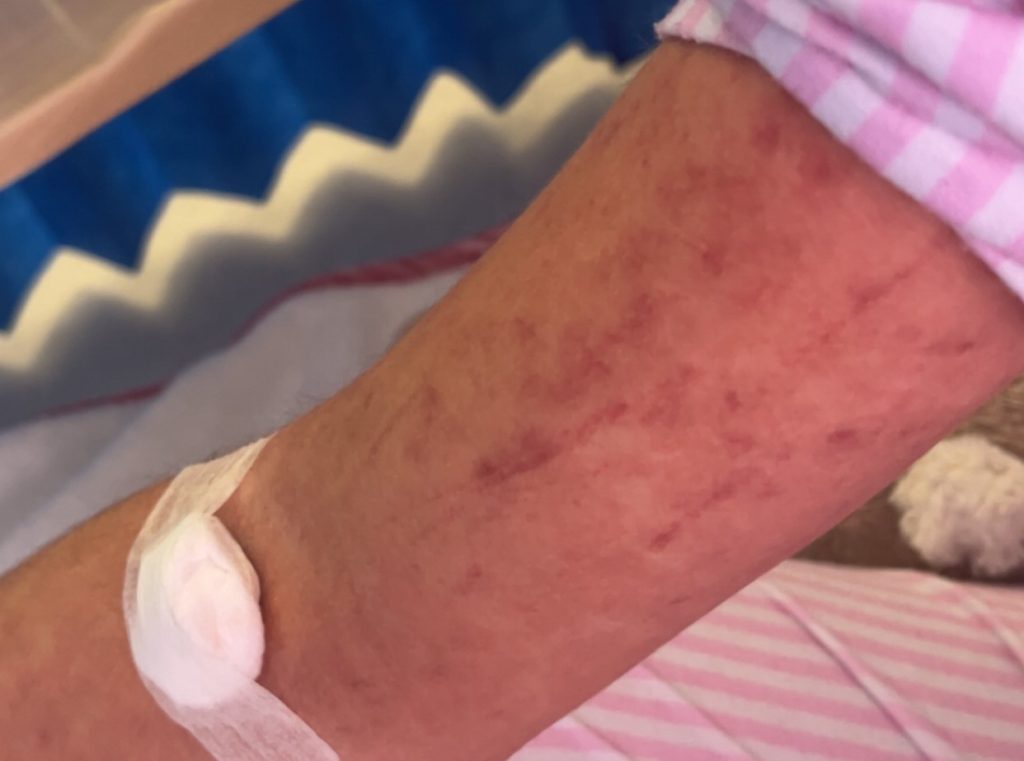 Childcare worker Mollie Lock, 18, thought she had flu - but ended up hospitalised with face swollen like a puffer fish after being struck down by glandular fever.