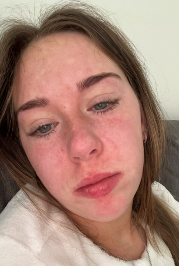 Childcare worker Mollie Lock, 18, thought she had flu - but ended up hospitalised with face swollen like a puffer fish after being struck down by glandular fever.
