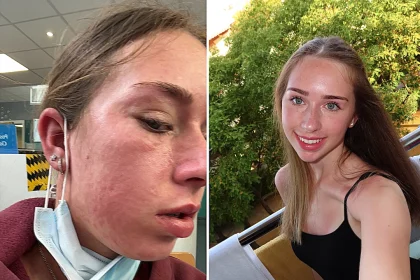 Childcare worker Mollie Lock, 18, thought she had flu - but ended up hospitalised with face swollen like a puffer fish after being struck down by glandular fever.
