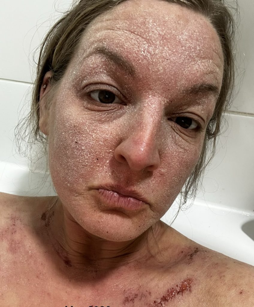 Woman speaks out about the horrifying reality of steroid cream usage - leaving her with agonisingly itchy burning skin that feels like she has been set on fire.