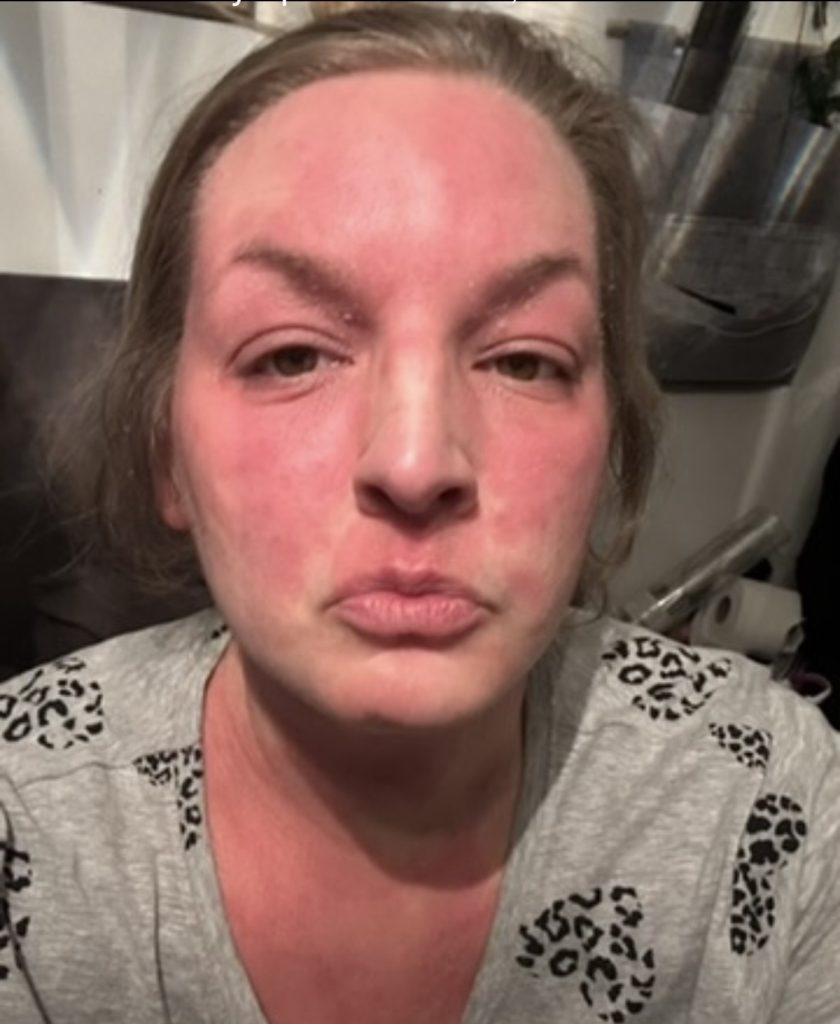 Woman speaks out about the horrifying reality of steroid cream usage - leaving her with agonisingly itchy burning skin that feels like she has been set on fire.