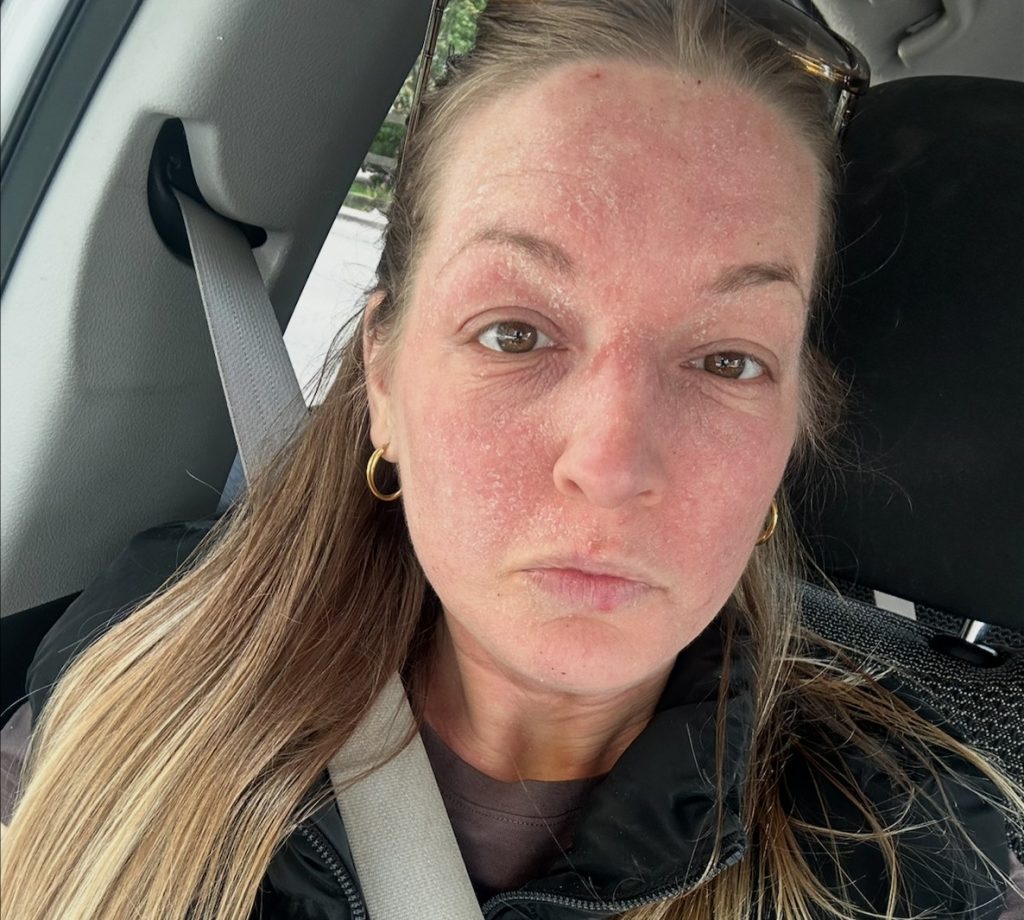 Woman speaks out about the horrifying reality of steroid cream usage - leaving her with agonisingly itchy burning skin that feels like she has been set on fire.