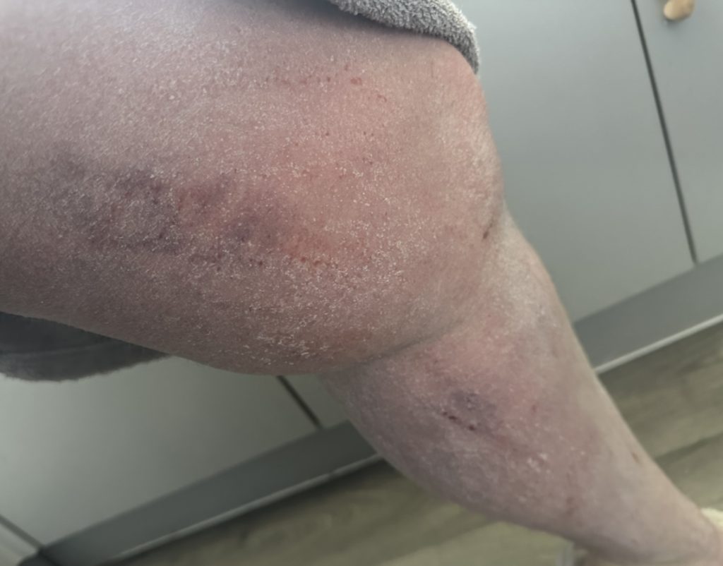 Woman speaks out about the horrifying reality of steroid cream usage - leaving her with agonisingly itchy burning skin that feels like she has been set on fire.