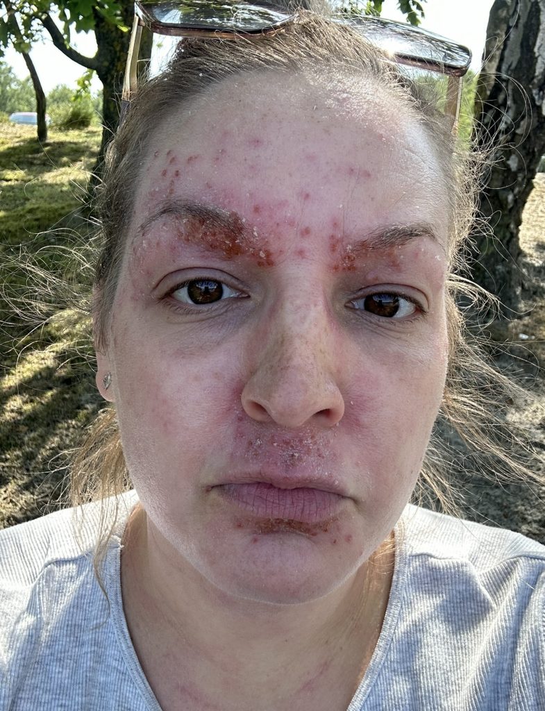 Woman speaks out about the horrifying reality of steroid cream usage - leaving her with agonisingly itchy burning skin that feels like she has been set on fire.