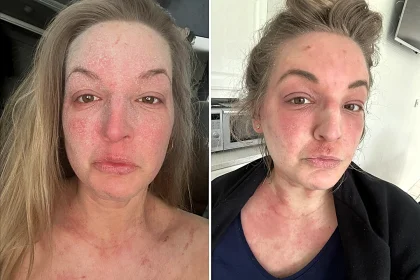 Woman speaks out about the horrifying reality of steroid cream usage - leaving her with agonisingly itchy burning skin that feels like she has been set on fire.