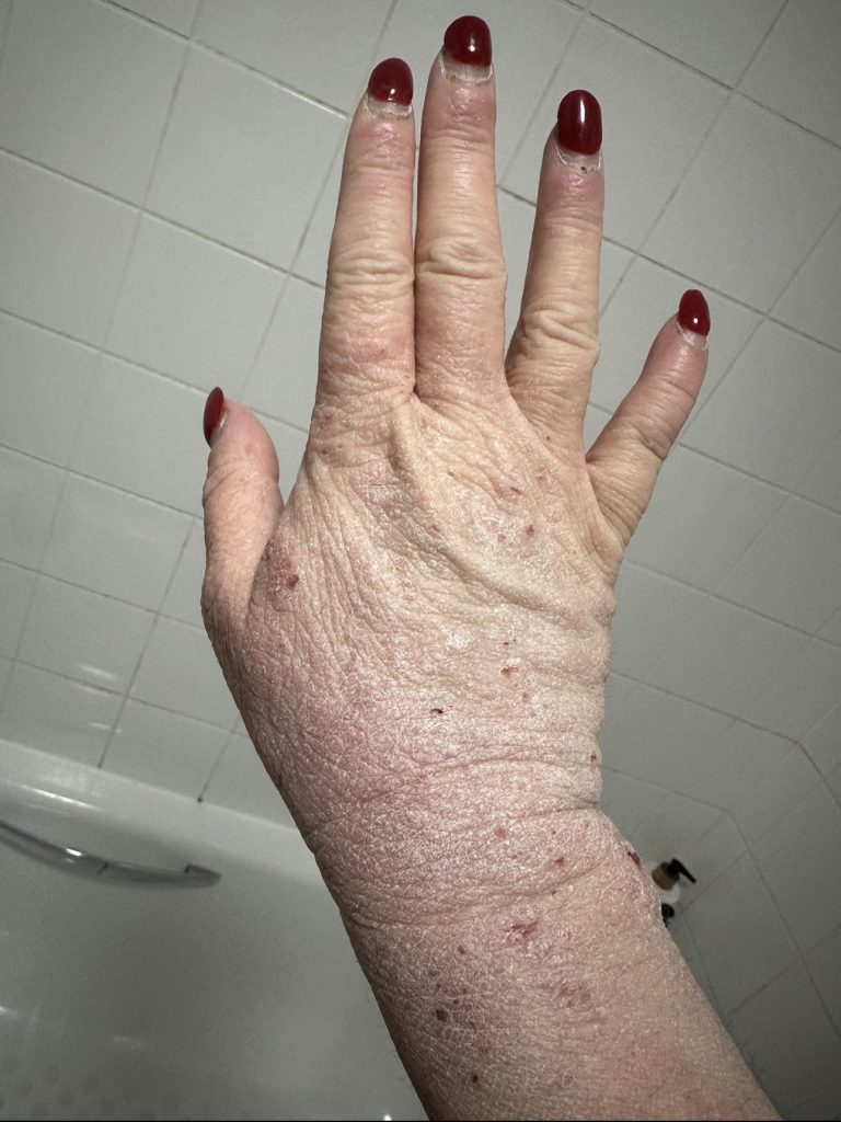 Woman speaks out about the horrifying reality of steroid cream usage - leaving her with agonisingly itchy burning skin that feels like she has been set on fire.