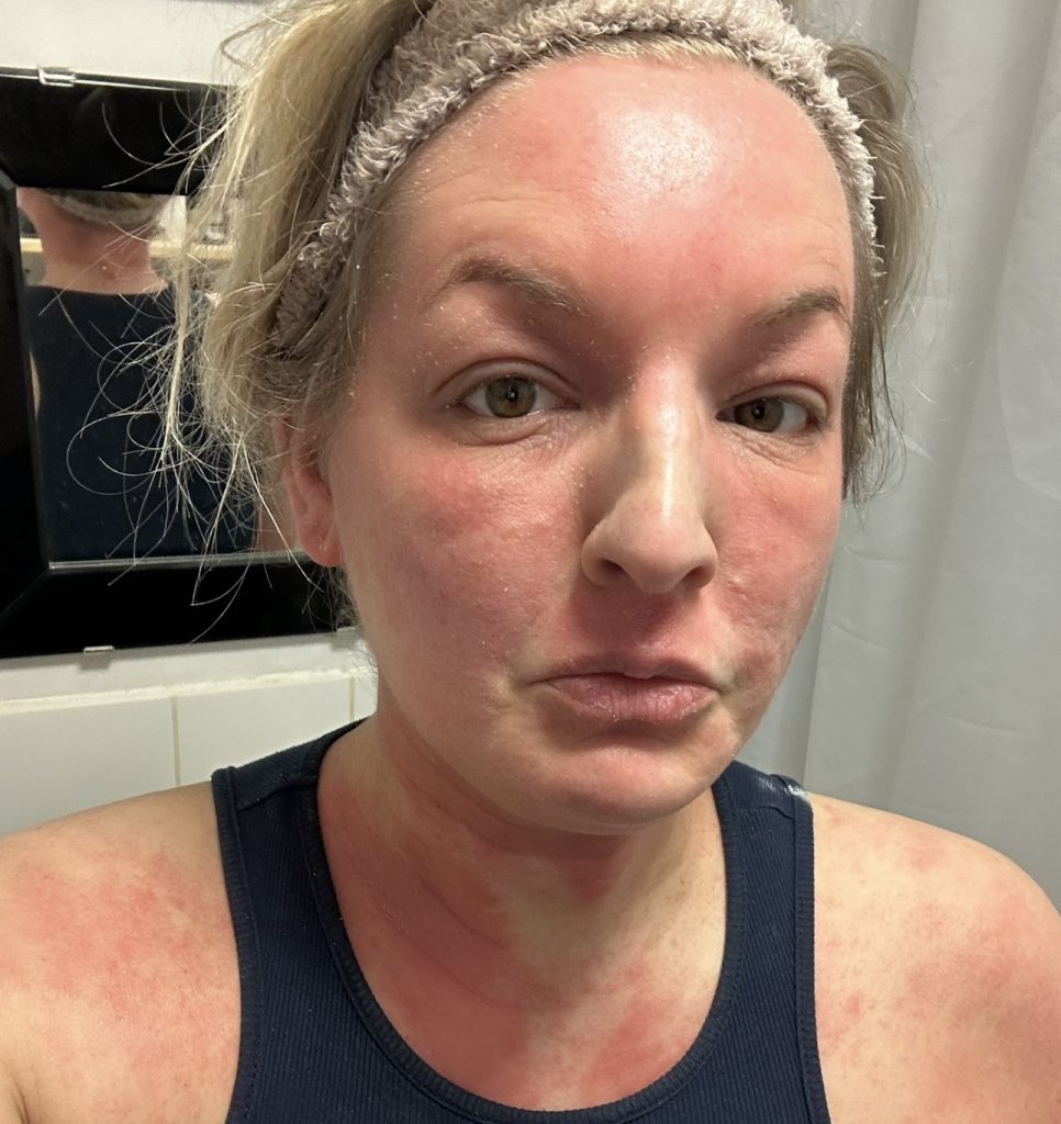 Woman speaks out about the horrifying reality of steroid cream usage - leaving her with agonisingly itchy burning skin that feels like she has been set on fire.