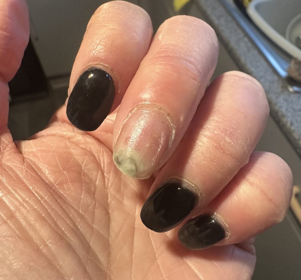 Woman speaks out about the horrifying reality of steroid cream usage - leaving her with agonisingly itchy burning skin that feels like she has been set on fire.
