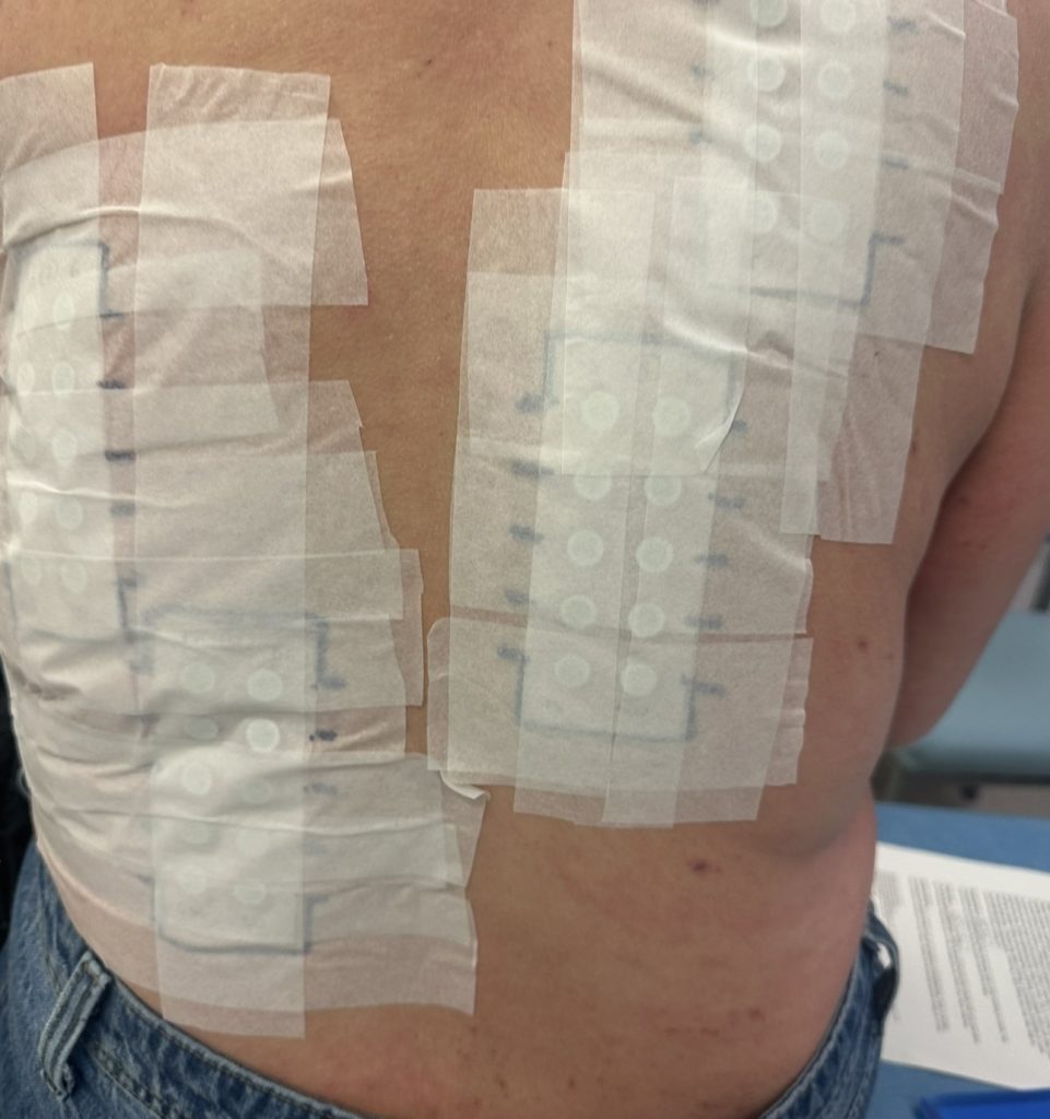 Woman speaks out about the horrifying reality of steroid cream usage - leaving her with agonisingly itchy burning skin that feels like she has been set on fire.