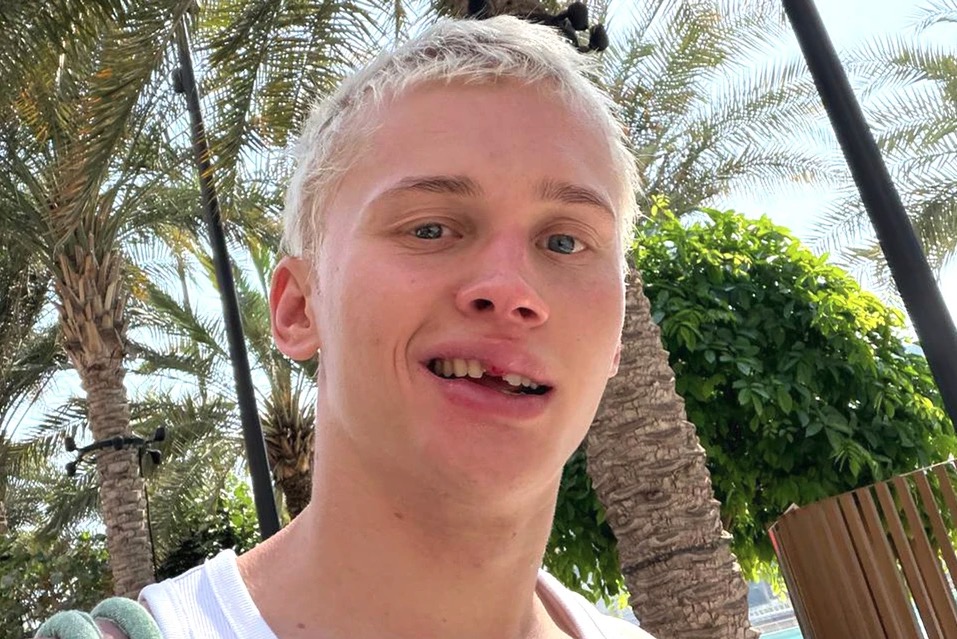 Influencer with over 20 million followers loses one of his front teeth after going down a children's slide at a swimming pool - and the embarrassing reason why.